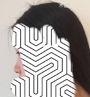 【分享经验】做了眼部手术和鼻部手术手术
