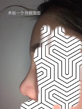 【分享经验】做了眼部手术和鼻部手术手术