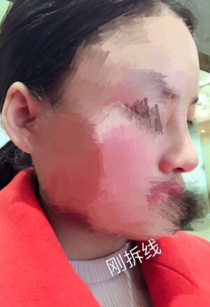 桐庐一家私立医院做的鼻部手术手术案例