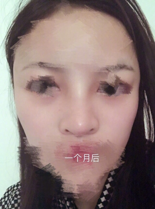桐庐一家私立医院做的鼻部手术手术案例