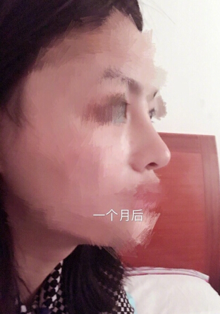 桐庐一家私立医院做的鼻部手术手术案例