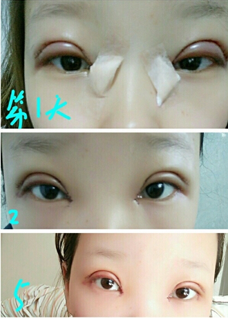 武汉华美王院长做的双眼皮开眼角手术案例