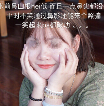 武汉美天医疗美容朱晓浩院长做的鼻部手术整形