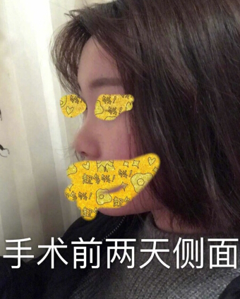 武汉美天医疗美容朱晓浩院长做的鼻部手术整形
