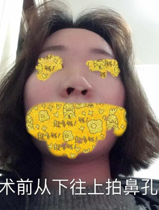 武汉美天医疗美容朱晓浩院长做的鼻部手术整形