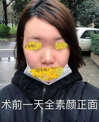 武汉美天医疗美容朱晓浩院长做的鼻部手术整形