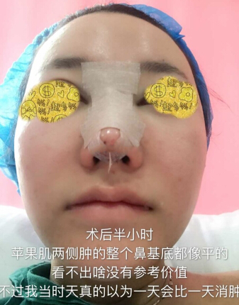 武汉美天医疗美容朱晓浩院长做的鼻部手术整形