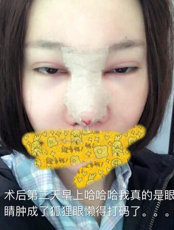 武汉美天医疗美容朱晓浩院长做的鼻部手术整形