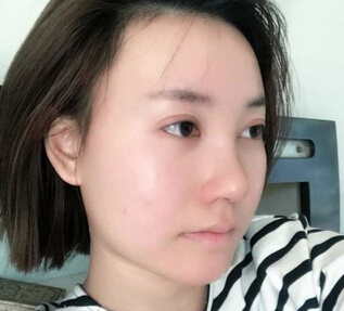 武汉美天医疗美容朱晓浩院长做的鼻部手术整形