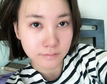 武汉美天医疗美容朱晓浩院长做的鼻部手术整形
