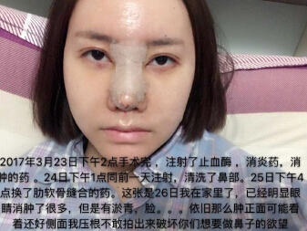 武汉美天医疗美容朱晓浩院长做的鼻部手术整形