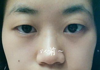 河南周口刘金刚医美整形双眼皮果怎么样？