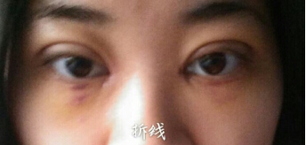 河南周口刘金刚医美整形双眼皮果怎么样？
