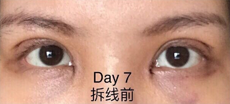 深圳私人医院金医生价格一万做的双眼皮