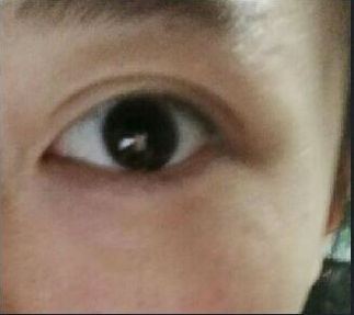 佳木斯谷永安医生做的双眼皮恢复后能对称么?