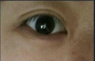 佳木斯谷永安医生做的双眼皮恢复后能对称么?