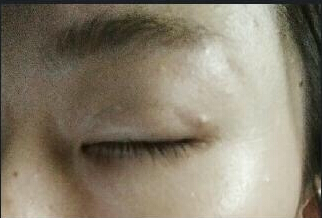 佳木斯谷永安医生做的双眼皮恢复后能对称么?