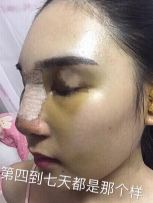东莞韩美医院温院长做的芭比鼻手术果