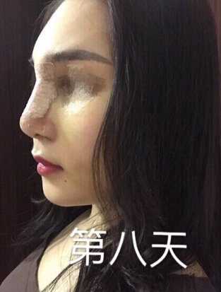 东莞韩美医院温院长做的芭比鼻手术果