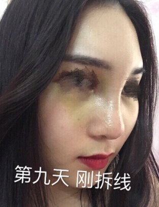 东莞韩美医院温院长做的芭比鼻手术果