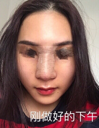 东莞韩美医院温院长做的芭比鼻手术果