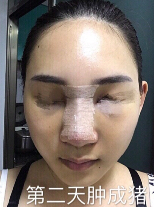 东莞韩美医院温院长做的芭比鼻手术果