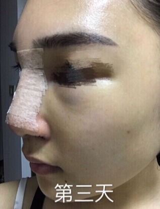 东莞韩美医院温院长做的芭比鼻手术果