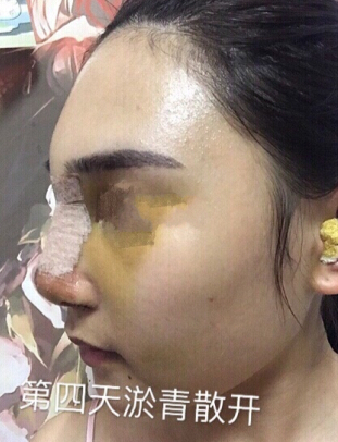 东莞韩美医院温院长做的芭比鼻手术果