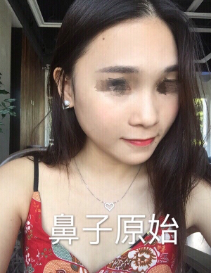 东莞韩美医院温院长做的芭比鼻手术果