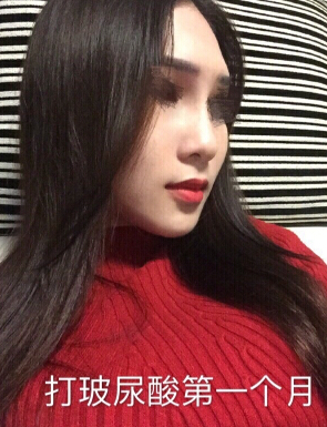 东莞韩美医院温院长做的芭比鼻手术果