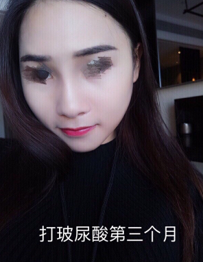 东莞韩美医院温院长做的芭比鼻手术果