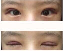 西安交通大学第二附属医院双眼皮手术案例