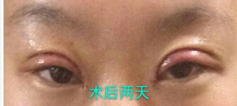 齐鲁医院李秀琪医生做的双眼皮开眼角手术