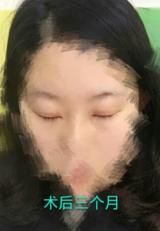 齐鲁医院李秀琪医生做的双眼皮开眼角手术