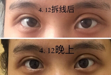 安徽省太和中医院价格2000多做的双眼皮手术