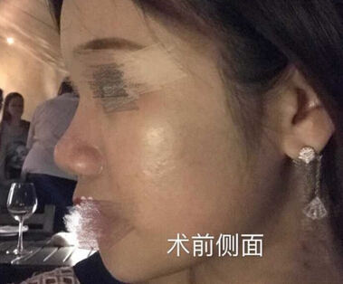 上海九院肖开颜医生做的鼻部手术手术案例