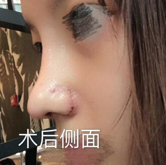 上海九院肖开颜医生做的鼻部手术手术案例