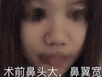 上海九院肖开颜医生做的鼻部手术手术案例