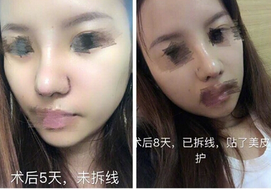上海九院肖开颜医生做的鼻部手术手术案例