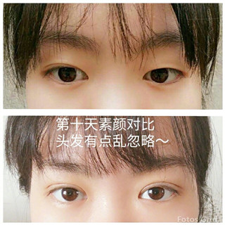 武汉天佑医院做的韩式三点双眼皮手术