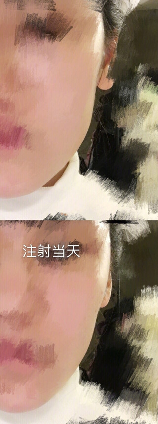 美国旧金山David W Kim MD诊所注射的注射瘦脸