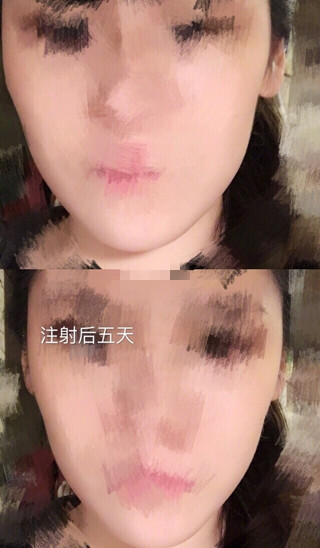 美国旧金山David W Kim MD诊所注射的注射瘦脸