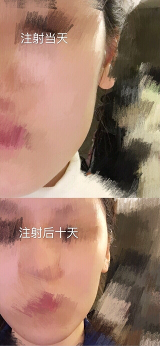 美国旧金山David W Kim MD诊所注射的注射瘦脸