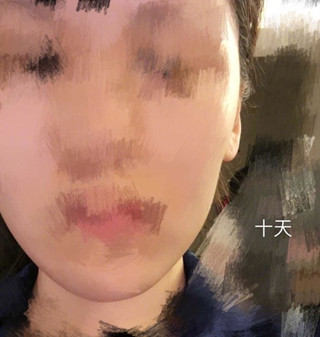 美国旧金山David W Kim MD诊所注射的注射瘦脸