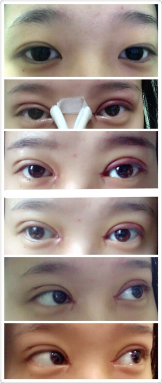 重庆华美何春涛医生做的双眼皮开眼角