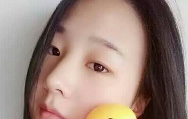 重庆五洲整形范文亮医生做的双眼皮和提肌