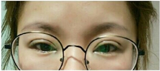 成都铜雀台徐墩医生做的双眼皮开眼角果