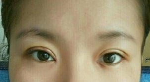 成都铜雀台徐墩医生做的双眼皮开眼角果