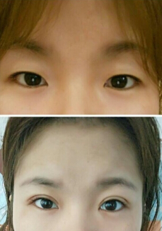 成都铜雀台徐墩医生做的双眼皮开眼角果