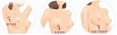 如何选择乳房植入物?